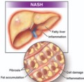 FDA首次批准非酒精性脂肪肝炎(MASH)治療藥物